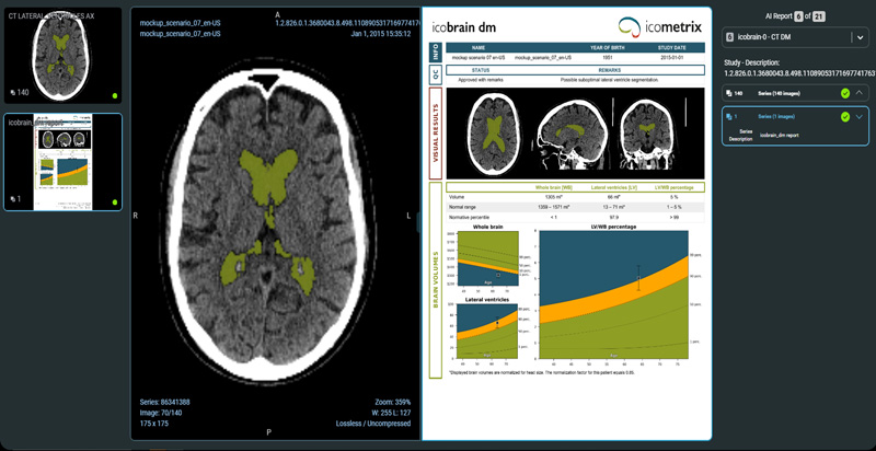 icobrain ct